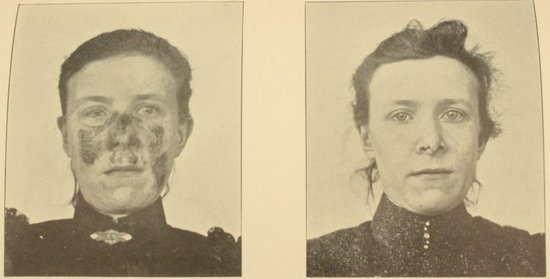 Før-og-efter-billede af en kvinde, der i 1898 modtog lysterapi mod lupus vulgaris ved Finsens Medicinske Lysinstitut