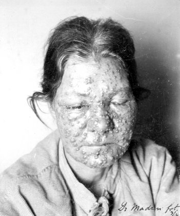 Fotografi af yngre kvinde, som var hårdt ramt af sygdommen ved en mindre epidemi i København i 1894